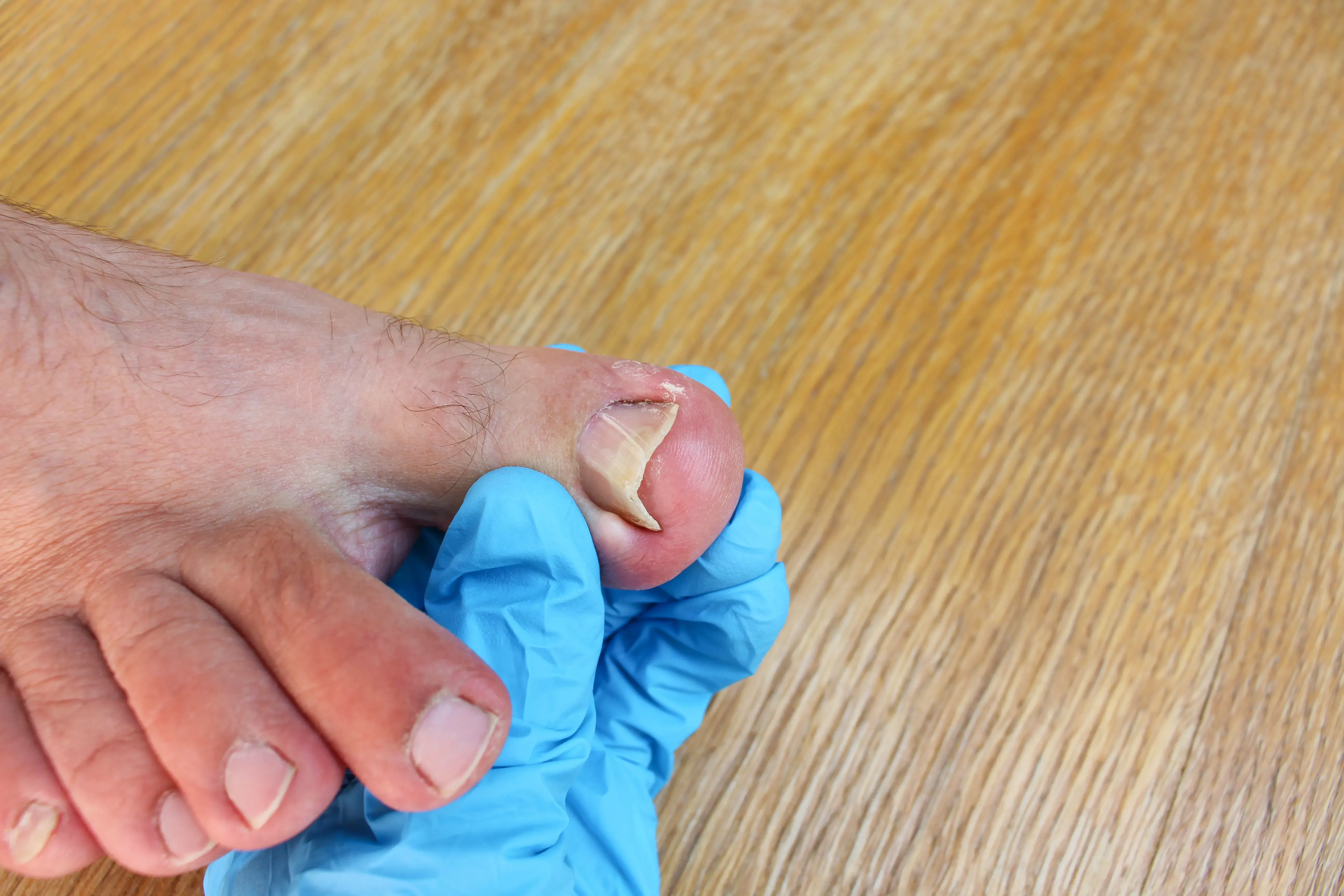 Is Toenail fungus contagious