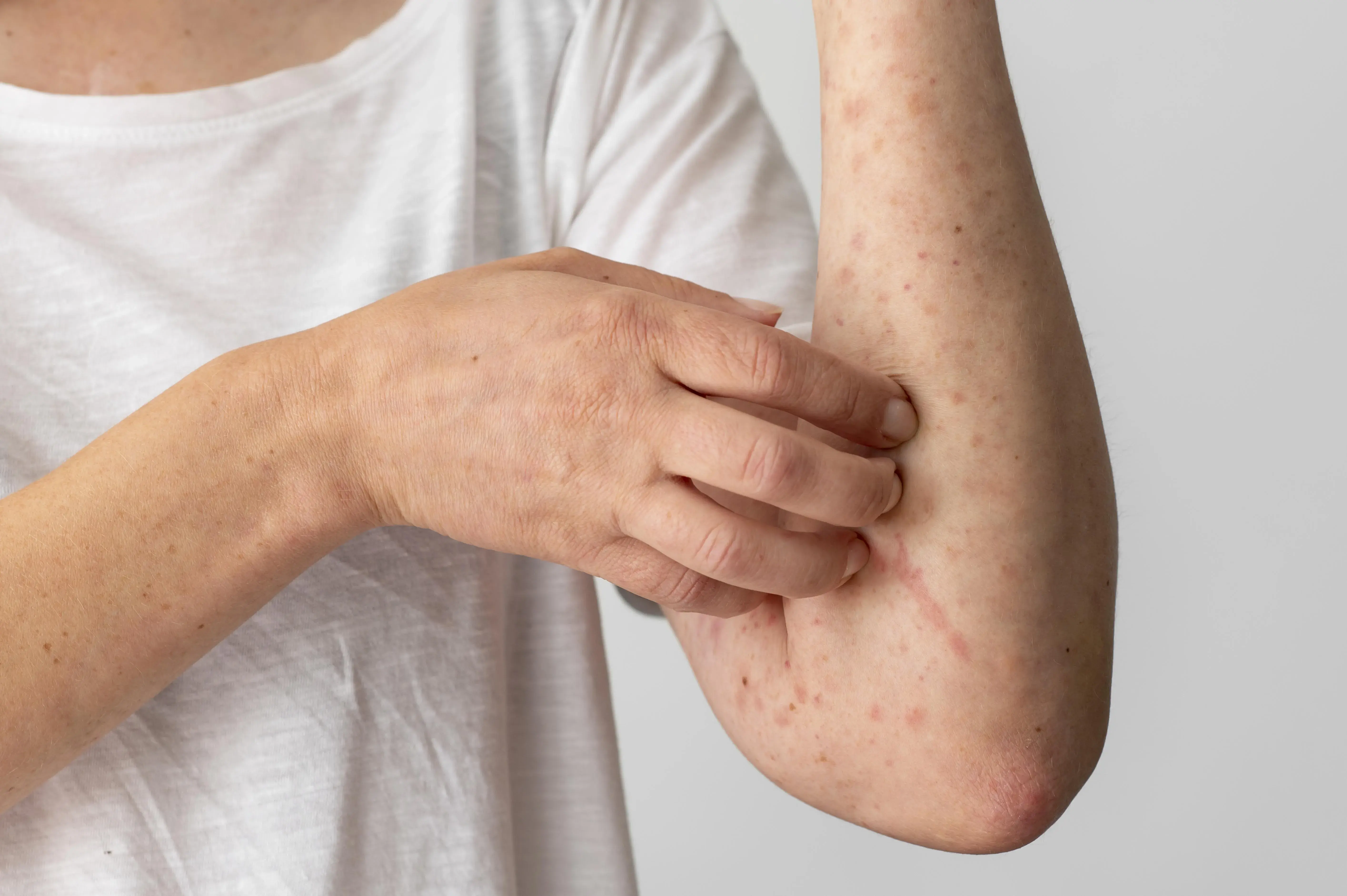 Allergic reaction