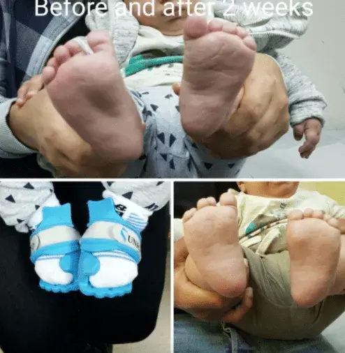 Neonatal Foot Orthotics system 