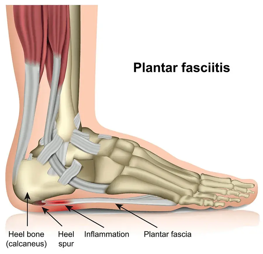 What is plantar fasciitis