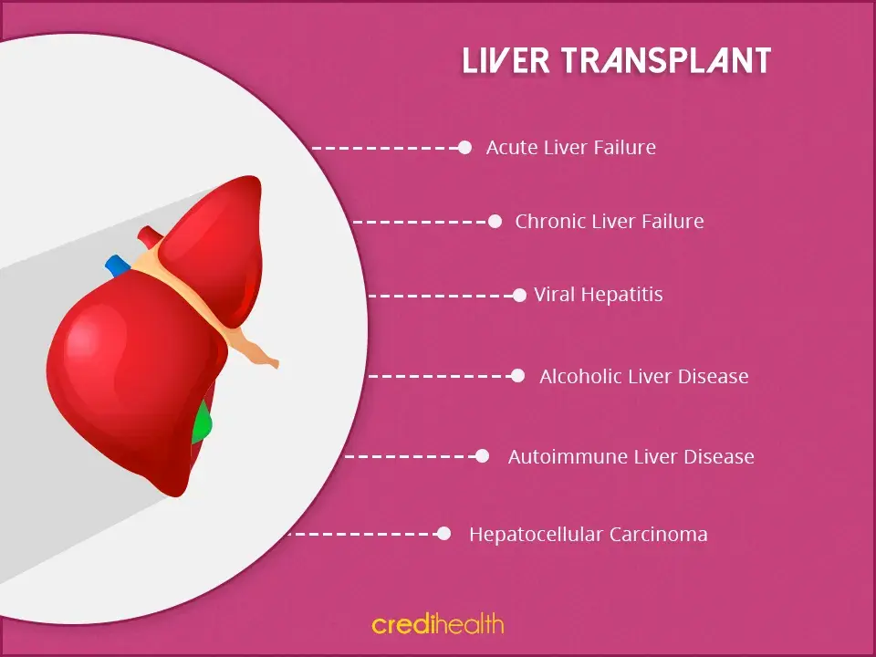 liver-transplant