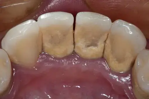 Dental Plaque - how to remove tartar from teeth