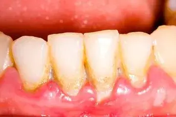Tartar - how to remove tartar from teeth