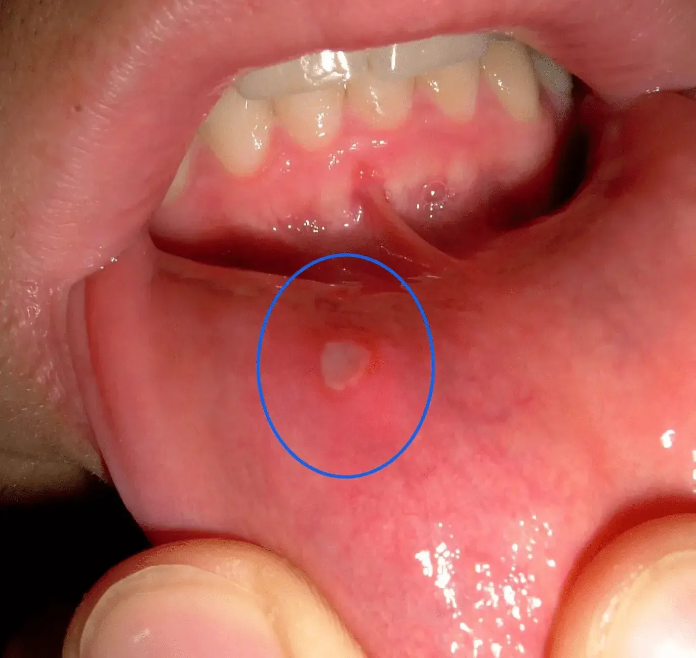 Risk factors and their causes of a canker sore