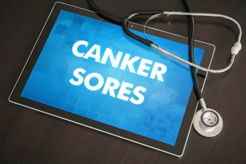 What Is a Canker Sore