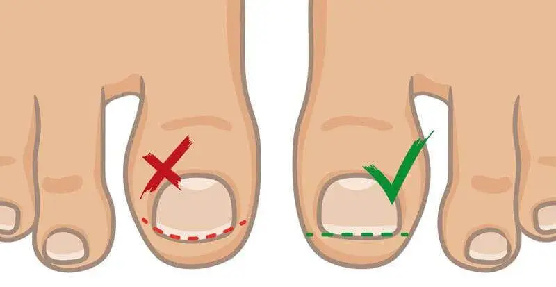 prevent ingrown toenails