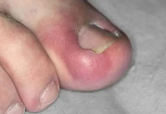 symptoms of an ingrown toenail