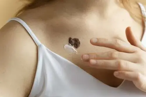 How to remove skin tags