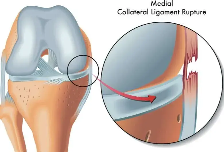 Medial collateral ligament (MCL)