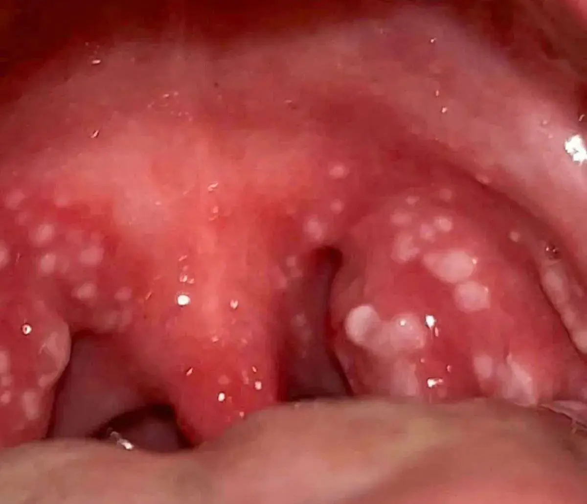 What does strep throat look like