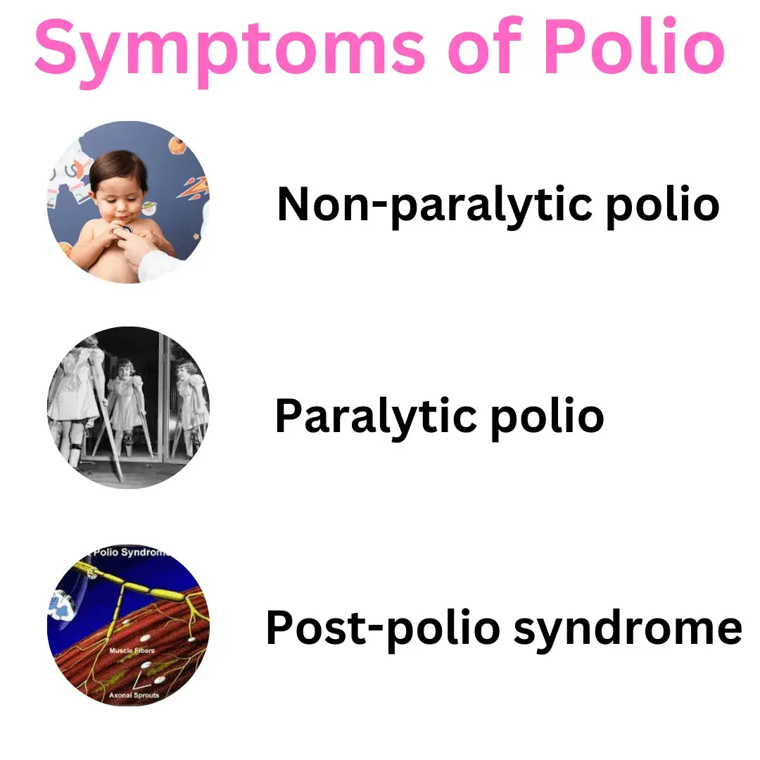 symptoms of polio