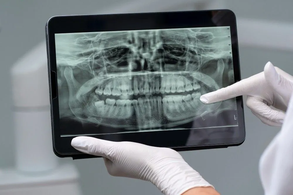 How Do Panoramic X-Rays Detect Wisdom Too...