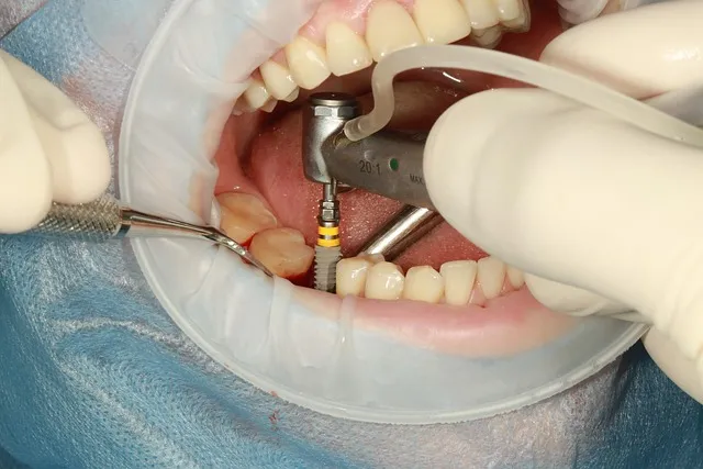 How to Clean and Maintain Your Dental Imp...