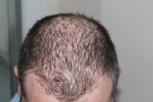 Hair Loss Causes: Why Shedding and Thinni...