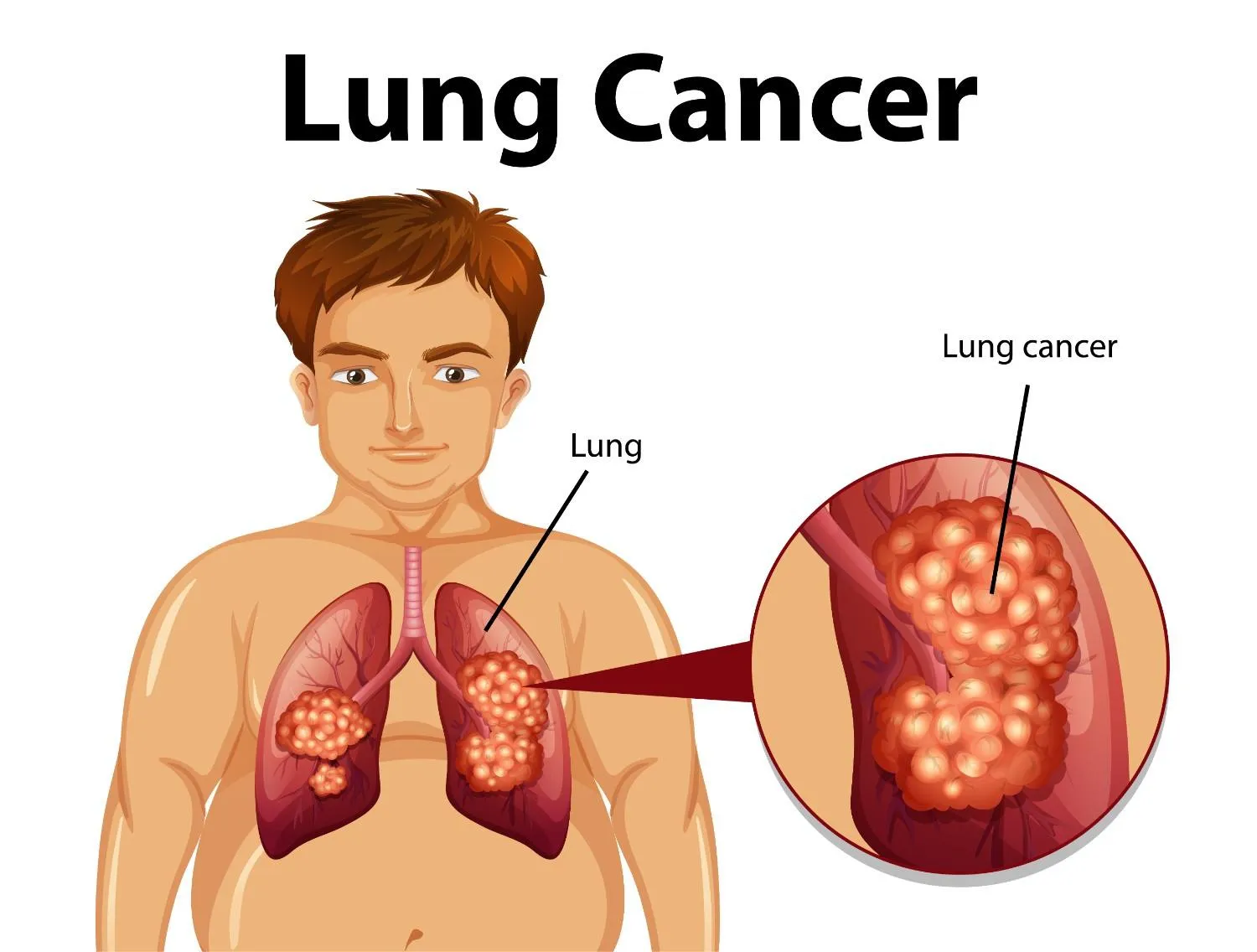 Why Lung Cancer Treatment Plans Differ Fr...