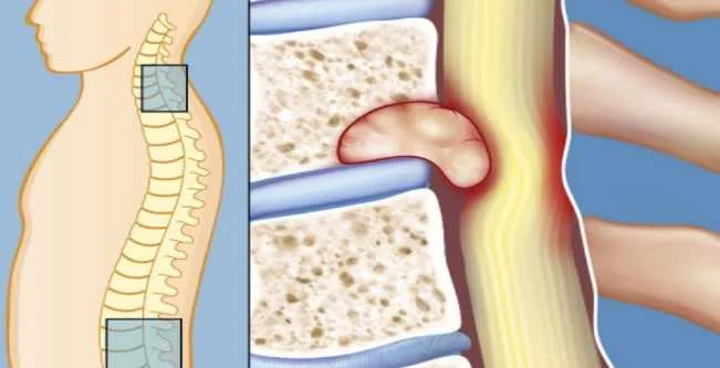 16 Different Types of Spinal Tumors and How to Spot Them ...