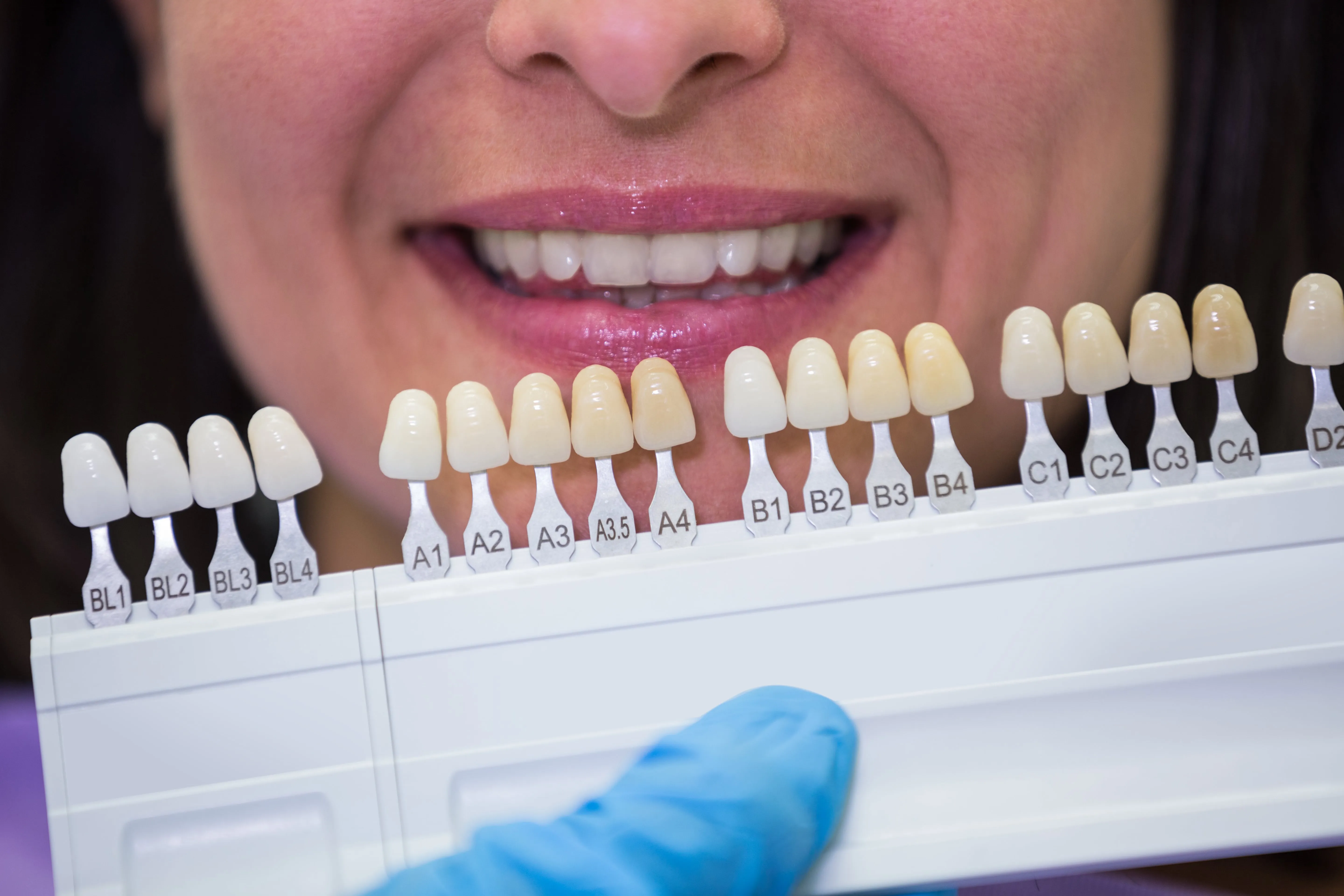 The 4 Types of Dental Crowns: Which One Is Right for You?...