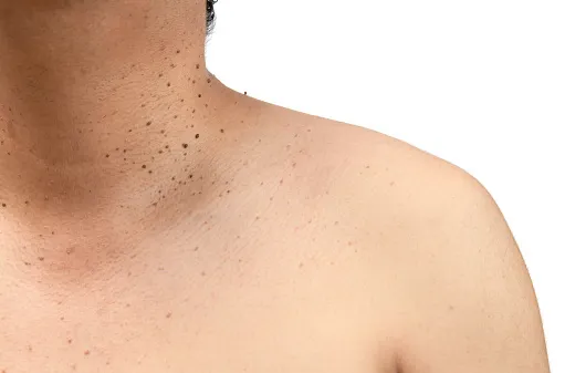 Anal Skin Tag: Causes, Removal, And Recovery | Updated 2026
